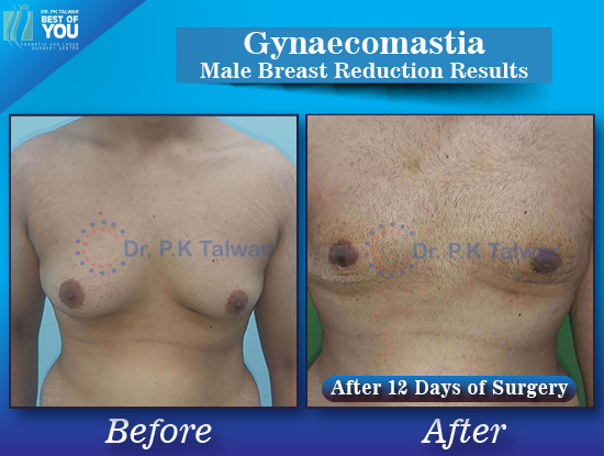 Gynaecomastia before after image